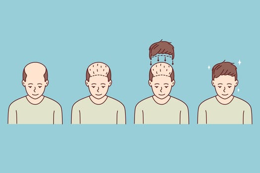 Stages on man hair transplant. Treatment of baldness and alopecia. Set of male patient follicular unit extraction. Vector illustration.