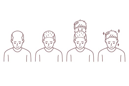 Stages on man hair transplant. Treatment of baldness and alopecia. Set of male patient follicular unit extraction. Vector illustration.