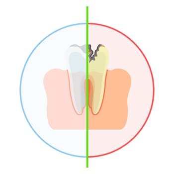 Tooth is healthy and damaged by caries, with hole. Flat vector cartoon illustration. Objects isolated on white background.