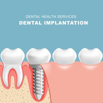 Gum section with dental implantat - row of teeth