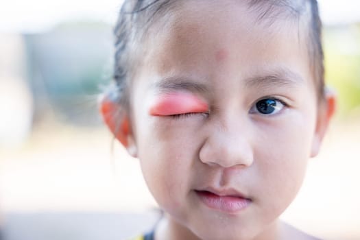 Stye Eye diseases. Closed Asian kid little girl eye with sty, eyelid abscess ophthalmic hordeolum