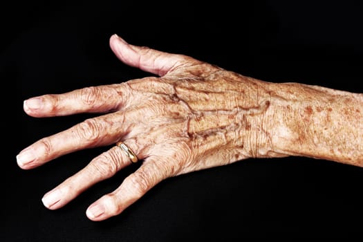 The aching hand of an old woman. An old woman has pain in her hands. The hand of an old woman