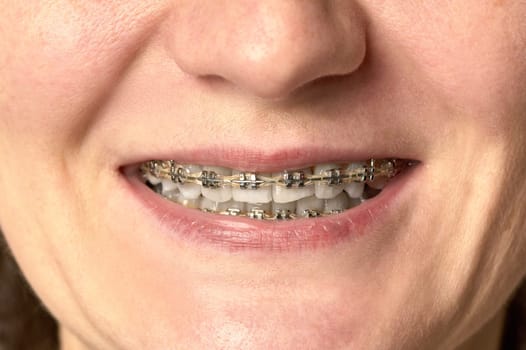 a woman's smile with open teeth on which there are braces. High quality photo