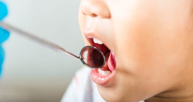 Dental kid health examination. Doctor examines oral cavity of little child uses mouth mirror to checking teeth cavity, Asian dentist making examination procedure for smiling cute little girl