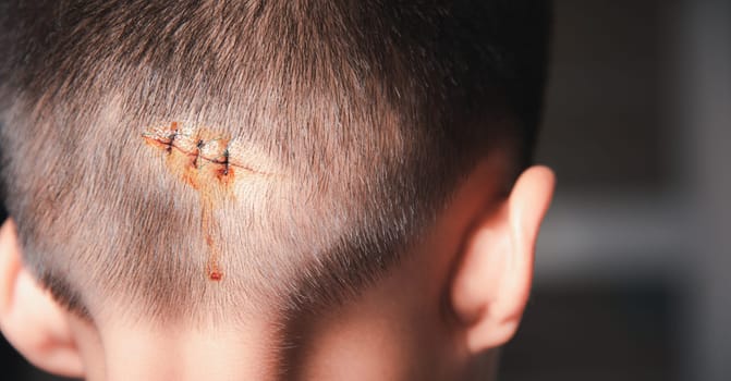 The lacerated sutured wound of kid back head which suture by nylon suture about 3 stitches at the emergency room of the hospital, Medical care of the surgery lesion on the head, children of Accident