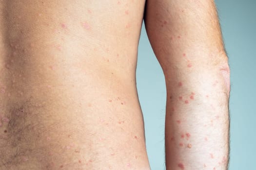Back view of bare elbow and back of unrecognizable man showing inflamed scaly flaky affected skin suffering from psoriasis on blue background. Autoimmune incurable skin disease, health, dermatology.