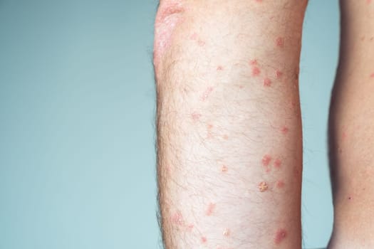 Close-up of bare elbow of unrecognizable man showing inflamed scaly flaky affected skin suffering from psoriasis on blue background. Autoimmune incurable skin disease, health, dermatology. Side view.