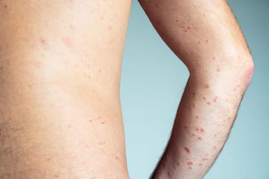 Back view of bare elbow and back of unrecognizable man showing inflamed scaly flaky affected skin suffering from chronic psoriasis on blue background. Autoimmune incurable skin disease, dermatology.