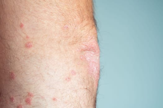 Close-up of bare elbow of unrecognizable man showing inflamed scaly flaky skin suffering from chronic psoriasis on blue background. Autoimmune incurable skin disease, health, dermatology. Side view.