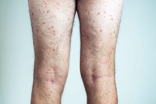 Back view of of bare legs of unrecognizable man showing inflamed scaly flaky skin suffering from psoriasis on blue background. Autoimmune incurable skin disease, healthcare, skincare, dermatology.