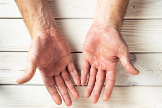 Top view of unrecognizable man suffering from psoriasis, showing dry thick scaly clusters, inflamed rash on skin of palms on white wooden background. Health, autoimmune genetic disease, dermatology.
