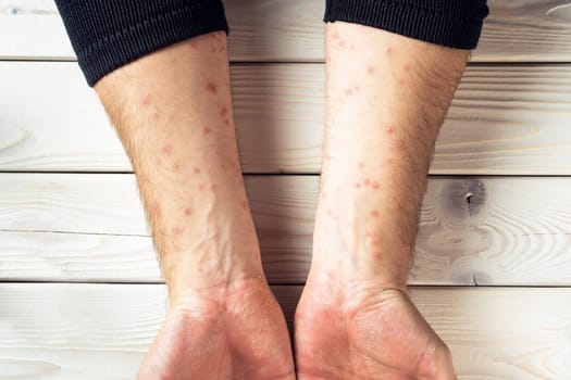 Top view of unrecognizable man suffering from psoriasis, showing thick scaly clusters, red inflamed rash on skin of arm on white wooden background. Healthcare, autoimmune genetic disease, dermatology.