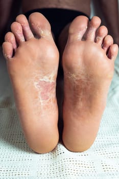 Cropped photo of half-naked man sitting on white sheet, showing peeling cracked inflamed flaky skin of feet and toes affected by psoriasis, fungal infection. Health, autoimmune incurable skin disease.