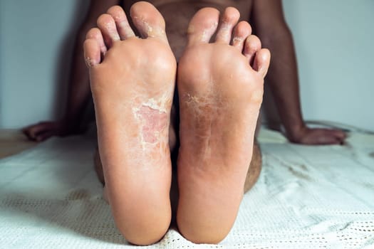 Cropped photo of half-naked man sitting on white sheet, showing peeling cracked inflamed flaky skin of feet and toes affected by psoriasis, fungal infection. Health, autoimmune skin disease, skincare.