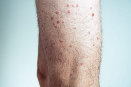 Side view of of bare legs of unrecognizable man showing inflamed scaly flaky skin suffering from psoriasis on blue background. Autoimmune incurable skin disease, healthcare, skincare, dermatology.