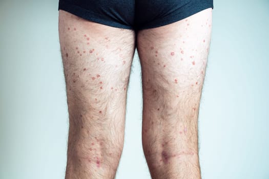 Back view of of bare legs of unrecognizable man wearing black underpants showing red inflamed scaly skin suffering from psoriasis on blue background. Autoimmune incurable skin disease, dermatology.