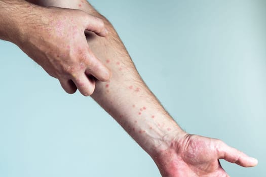 Unrecognizable man suffering from psoriasis scratching thick scaly clusters, flaky rash on skin of arm with affected fingers on blue background. Health, autoimmune incurable skin disease, dermatology.