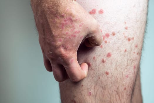 Unrecognizable man suffering from psoriasis, scratching thick scaly clusters, inflamed rash on skin of leg with affected fingers on white background. Health, autoimmune genetic disease, dermatology.