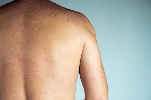 Close-up of inflamed flaky itchy skin of bare back with blemishes of unrecognizable man suffering from psoriasis on blue background. Health, skincare, autoimmune incurable skin disease, dermatology.