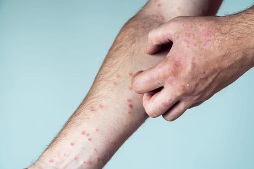 Cropped photo of man suffering from psoriasis scratching thick scaly clusters, red rash on skin of arm with affected fingers on blue background. Health, autoimmune incurable skin disease, dermatology.