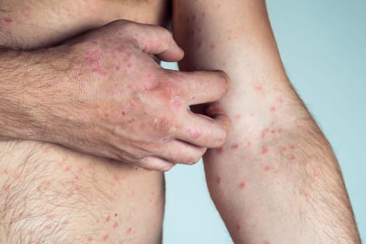 Cropped photo of half-naked man suffering from psoriasis scratching thick scaly clusters, red rash on skin of arm with affected fingers on blue background. Health, autoimmune incurable skin disease.