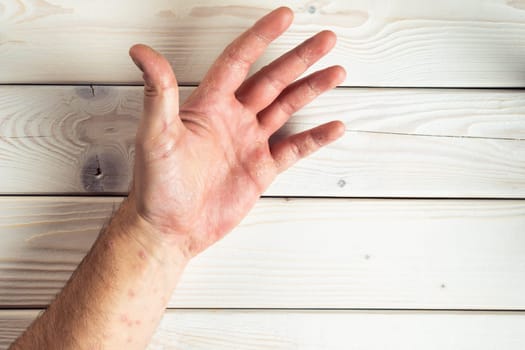 Top view of unrecognizable man suffering from psoriasis, showing thick scaly clusters, rash on skin of palm, fingers, arm on white wooden background. Health, autoimmune genetic disease, dermatology.
