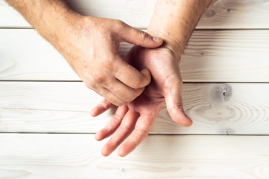 Top view of unrecognizable man suffering from psoriasis, scratching inflamed, flaky rash on skin of palm with fingers on white wooden background. Healthcare, autoimmune genetic disease, dermatology.