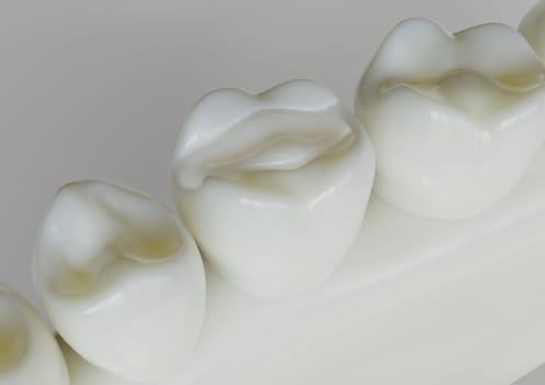 Ceramic Inlay crown in a totth - 3D Rendering