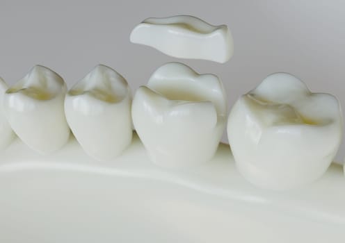 Ceramic Inlay crown over a totth - 3D Rendering