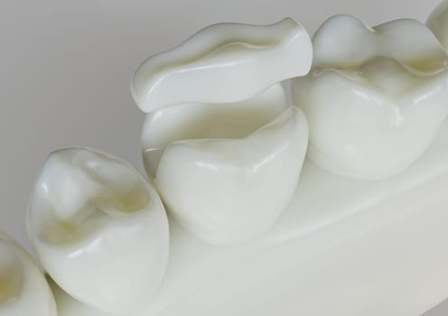 Ceramic Inlay crown over a totth - 3D Rendering