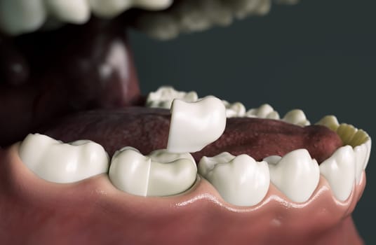 Ceramic Onlay quarter crown over a tooth- 3D Rendering