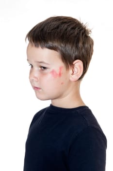 sad boy with a scraped face