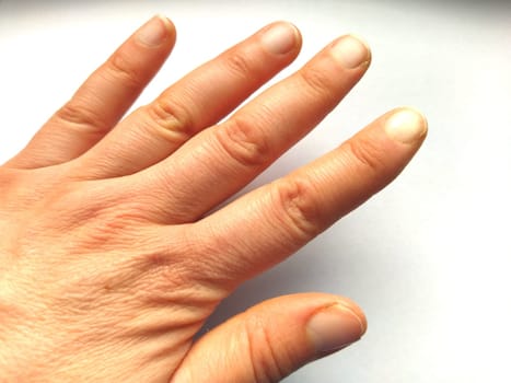 Female hand with dry atopic skin. White background. Close-up of the skin on the hands and fingers. Derma in need of care and hydration. Wrinkles, dryness and surface irritation. Natural clipped nails