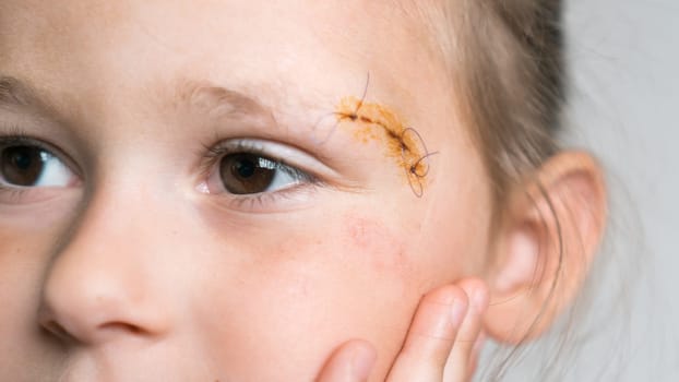 Close up sad, drear cropped cute girl face with stitches on scratch of eyebrow dissection, looking away. Pain relief and scar skin protection. Medicine aid and treatment. Clean scar, wounds.