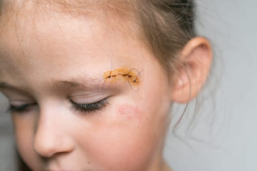 Close up sad, brave, drear cropped girl face with stitches on scratch of eyebrow dissection, looking down. Medicine aid and treatment. Pain relief and scar skin protection. Clean scar, wounds.