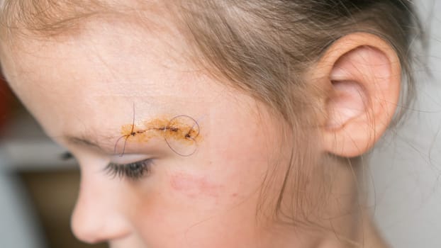 Close up sad, brave, drear cropped girl face with stitches on scratch of eyebrow dissection, looking down. Medicine aid and treatment. Pain relief and scar skin protection. Clean scar, wounds.