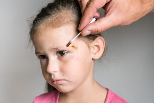 Close up almost crying kid girl face with cropped man hand healing and cleaning trauma with Iodine on cotton swab, painful scratch on head. Children injuries and family abuse. Clean scar, wounds.