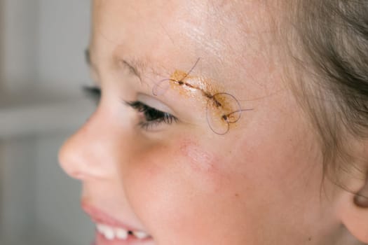 Close up smiling patient kid girl face with stitches, joints on scratch of eyebrow dissection looking away. Clean scar, wounds. Pain relief and scar skin protection. Medicine aid and treatment