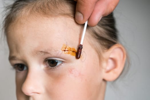 Close up sad, patient kid girl face with cropped man hand healing, apply Iodine on cotton swab to stitches on scratch on head. Children physical injuries and family abuse. Clean scar, wounds.