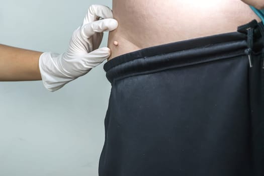 Skin tag or acrochondon or soft fibroma is a safe. It have not effect to the body. It usually occurs at neck, face, armpits and body.