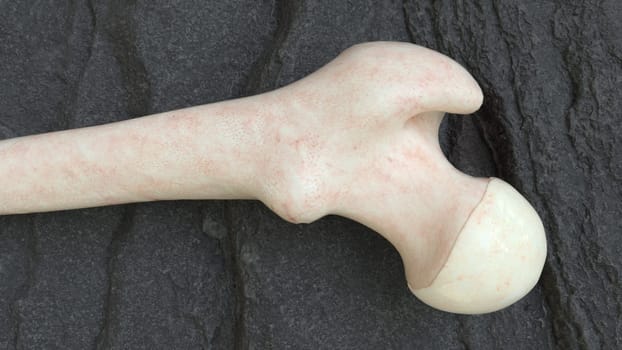 osteoporosis thigh bones from the outside -- 3d rendering