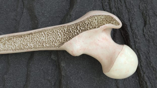 osteoporosis thigh bones from the inside -- 3d rendering
