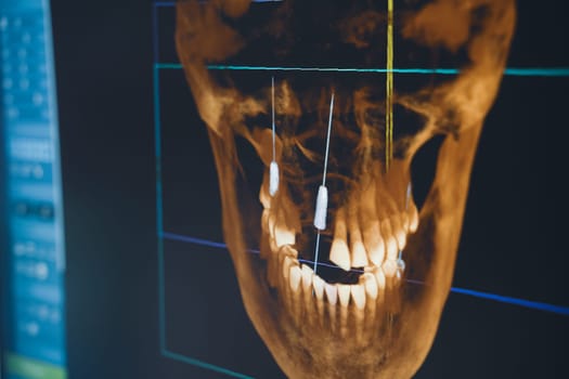 closeup of software interface of dental radiography x-ray on digital screen in dental clinic