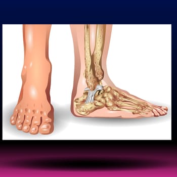 Foot and ankle pain. Vector illustration of human foot and ankle injury.