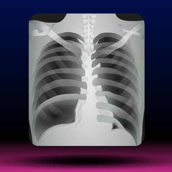 Illustration of X-ray of a human chest