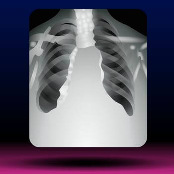 Chest X-ray, Heart, Lungs, Bones and Rib Cage