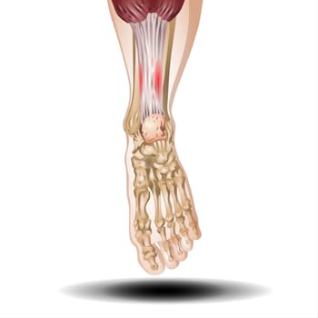 Arthritis foot joint in front view. Pain in leg. Human bone anatomy flat vector illustration
