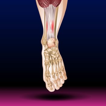 The leg from the knee to the ankle is called the crus. The calf is the back portion, and the tibia or shinbone together with the smaller fibula make up the front of the lower leg.