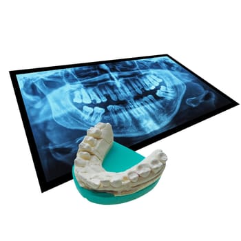 Medical X ray imaging of human teeth with positive dental mould reproduction cast formed from a negative dental impression of teeth isolated over white