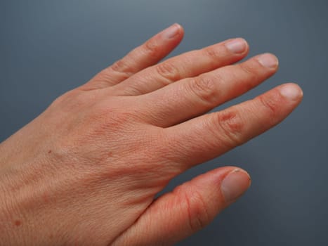 Female hand with dry atopic skin. White background. Close-up of the skin on the palm and fingers. Derma in need of care and hydration. Dermatological problems. Unpainted natural nails.